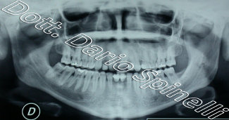 radiografia agenesia dentale dopo trattamento