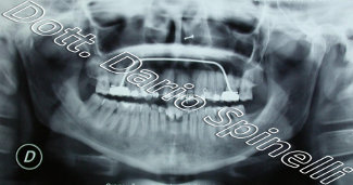 radiografia agenesia dentale prima del trattamento