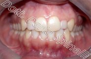affollamento dentale cross-bite laterale invisalign vista frontale dopo