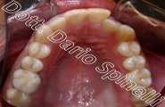 affollamento dentale cross-bite laterale invisalign arcata superiore prima