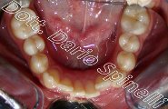 affollamento dentale cross-bite laterale invisalign arcata inferiore prima