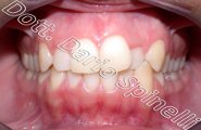 affollamento dentale cross-bite laterale invisalign vista frontale prima